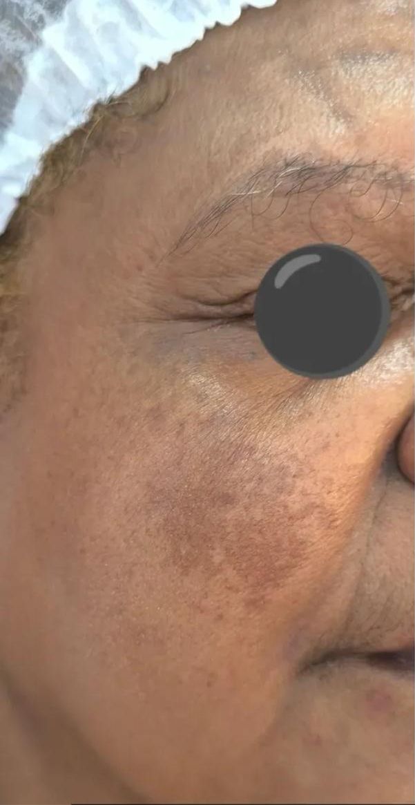 Antes - Manchas e melasma