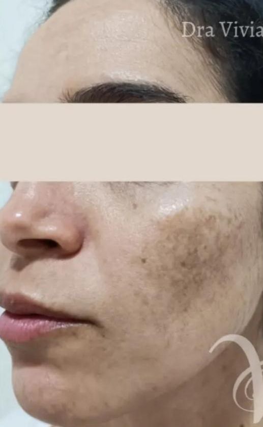 Antes - Melasma facial