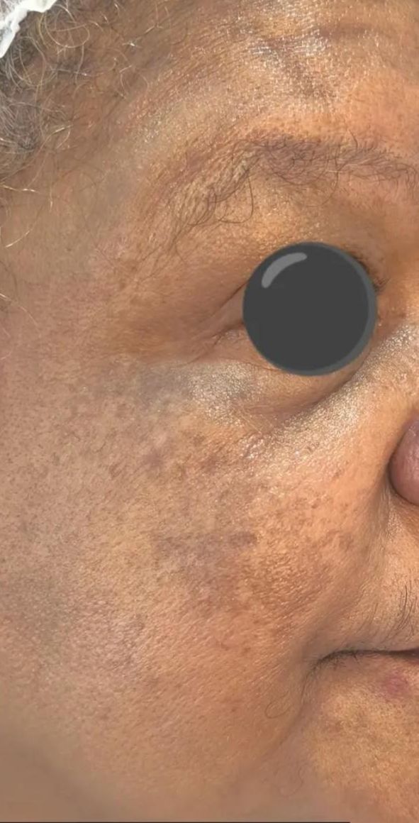 Depois - Manchas e melasma