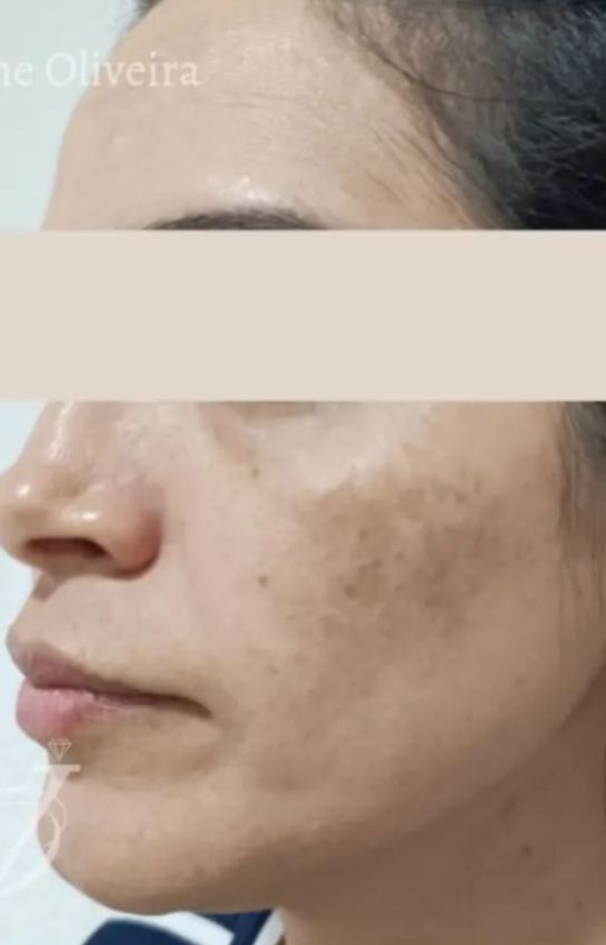 Depois - Melasma facial