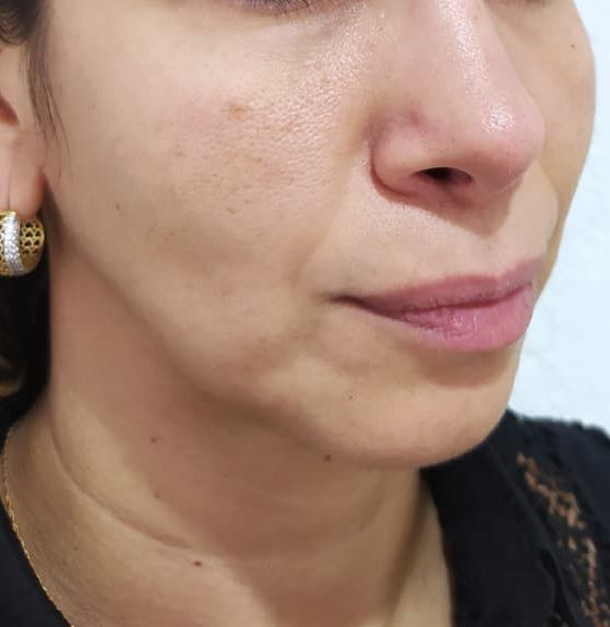 Antes — Textura e firmeza