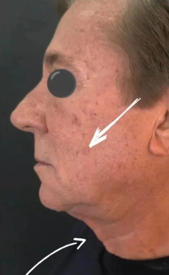 Antes — Lifting facial