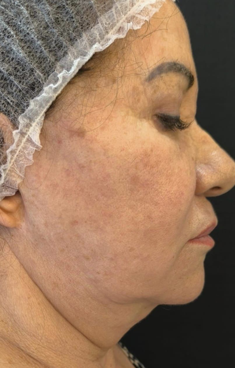 Antes — Rejuvenescimento facial