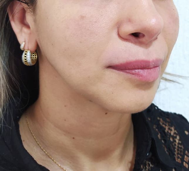 Depois — Textura e firmeza