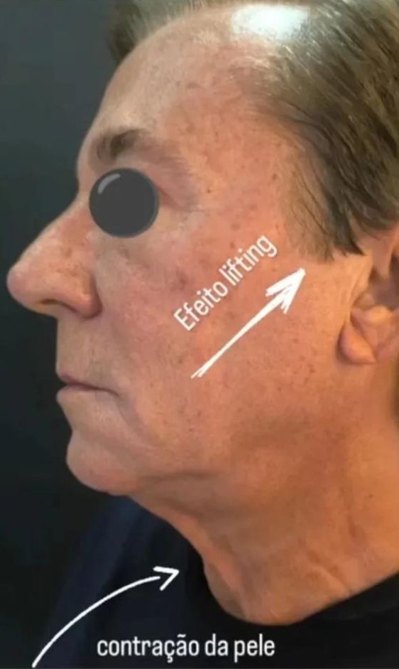 Depois — Lifting facial