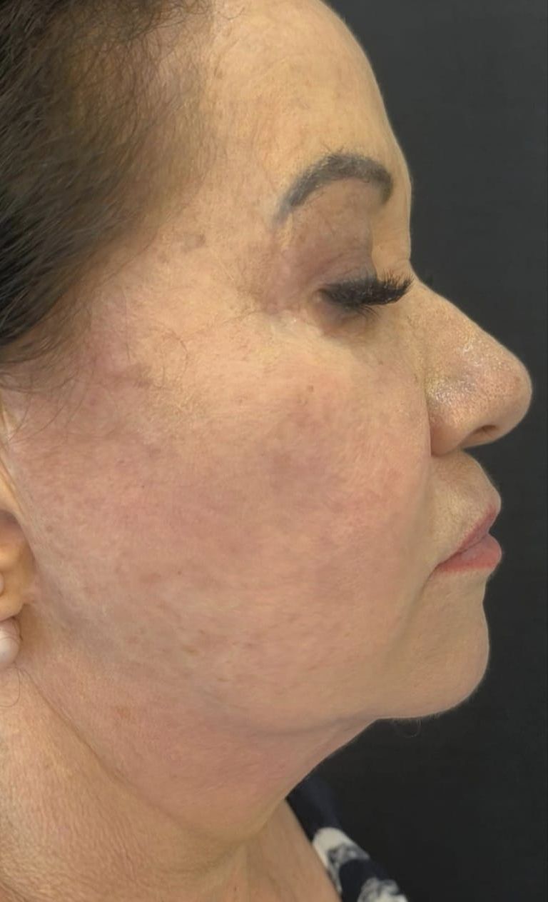 Depois — Rejuvenescimento facial